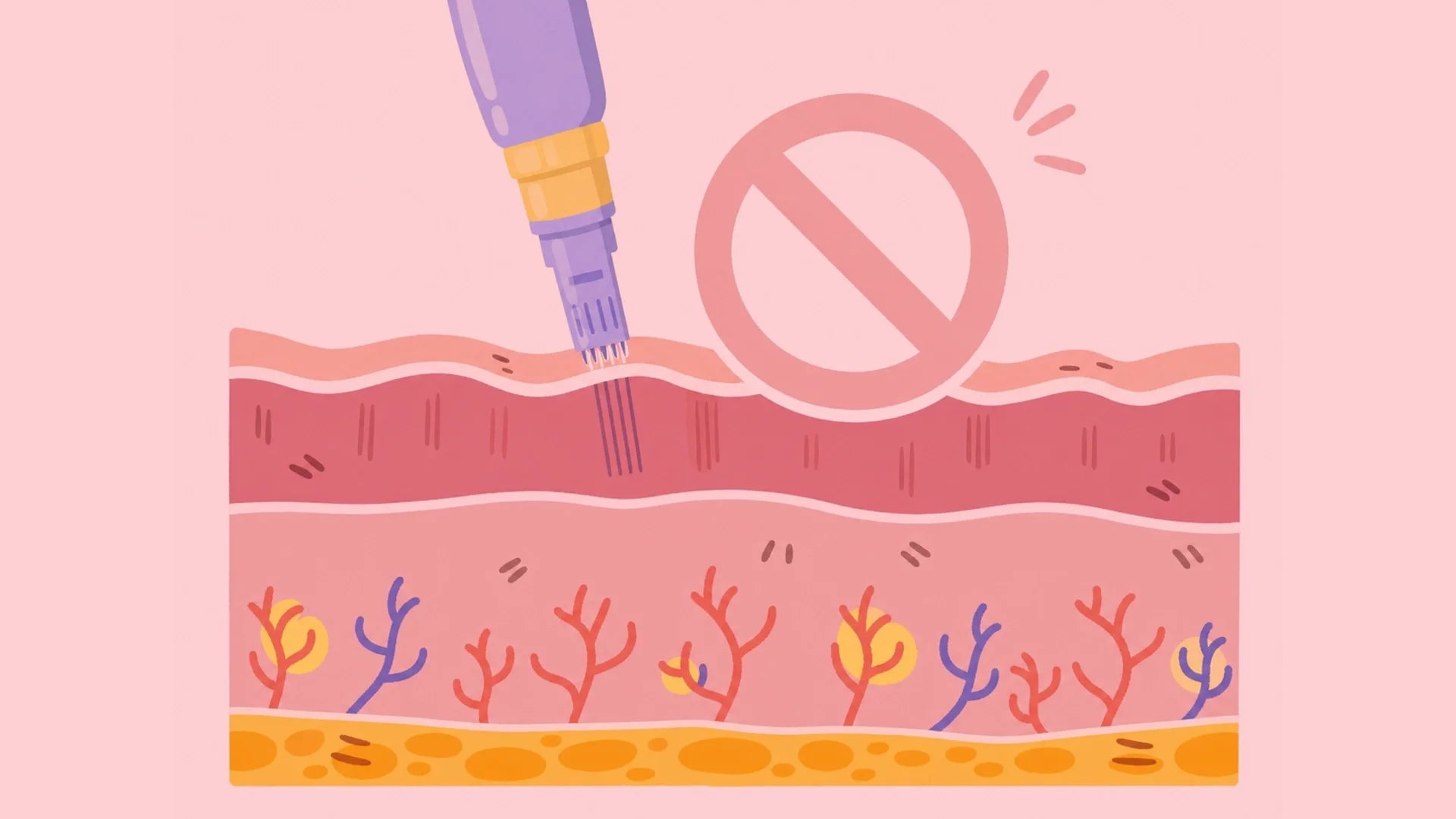 Stop microneedling - It makes melasma worse, not better
