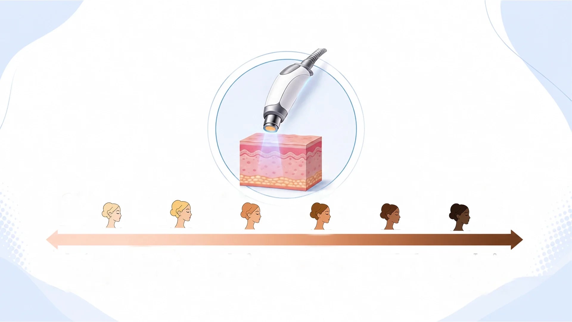 Post Laser Hyperpigmentation - Why you can get darker after your treatment