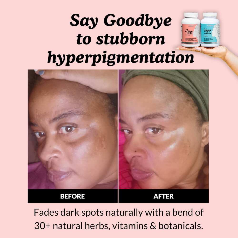 Before and after comparison of skin with hyperpigmentation, featuring a product for fading dark spots.