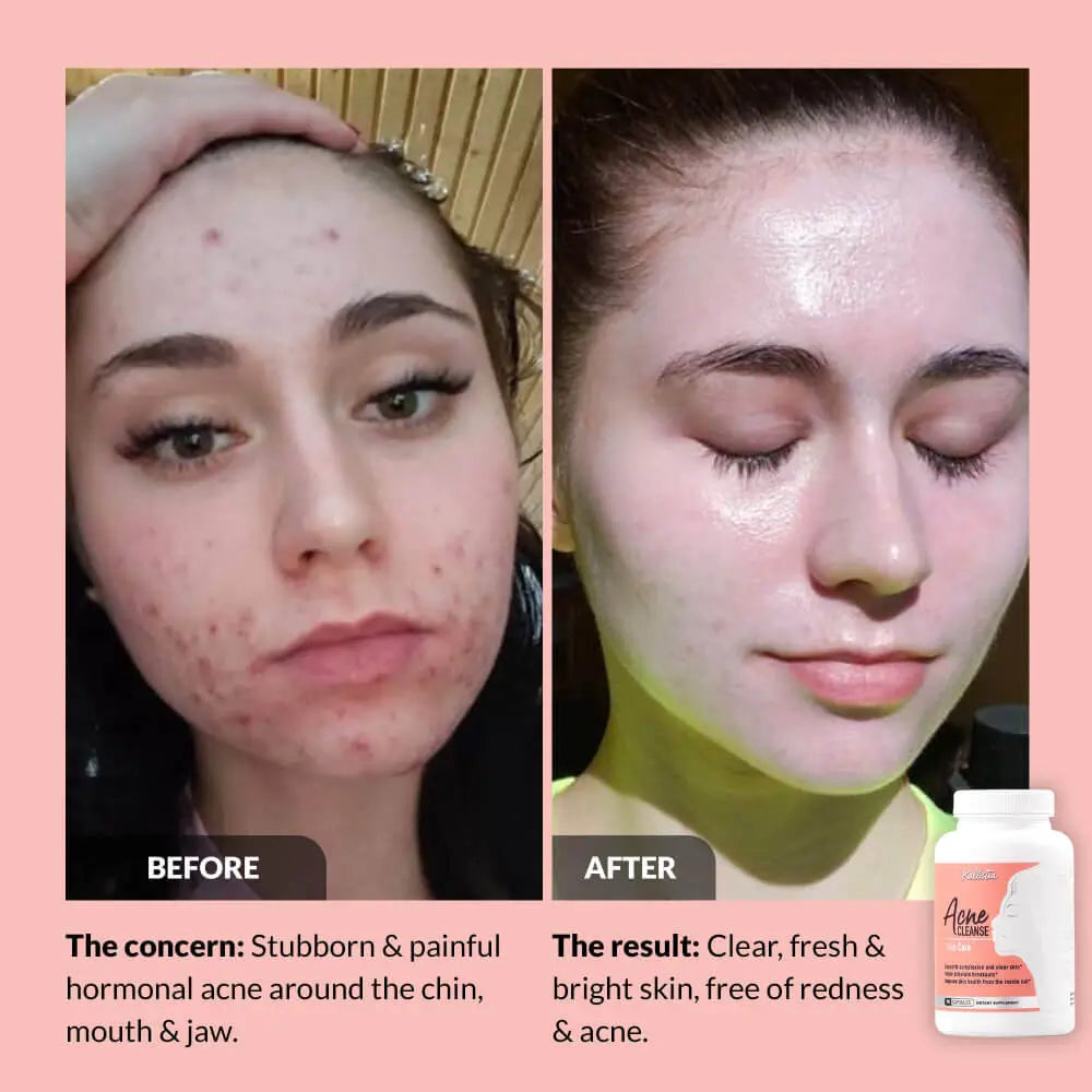 Acne Cleanse Capsules