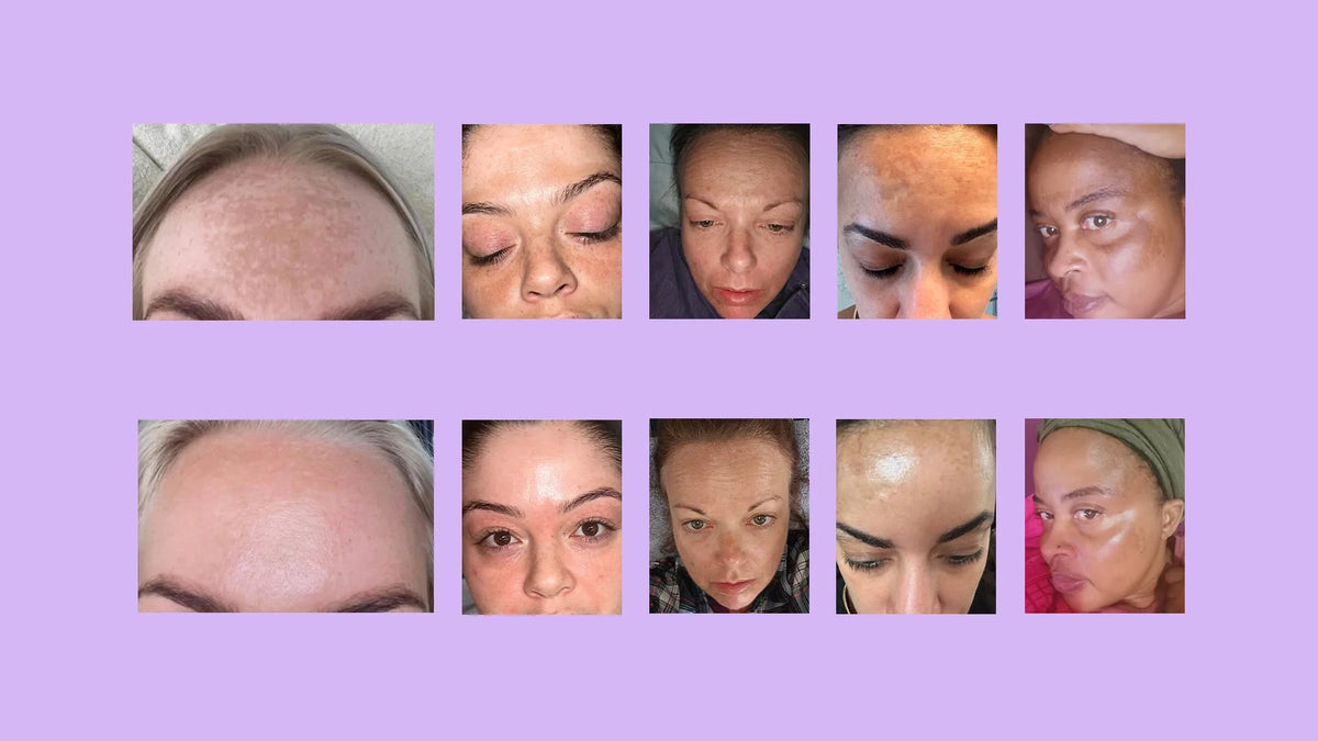 Why is forehead pigmentation so hard to fade?