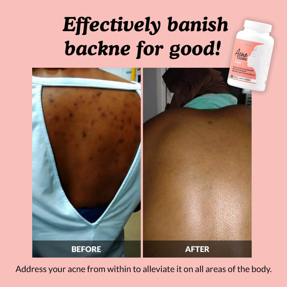 Before and after comparison of a person's back with acne, showing a bottle of Acme Vitamins on a pink background.