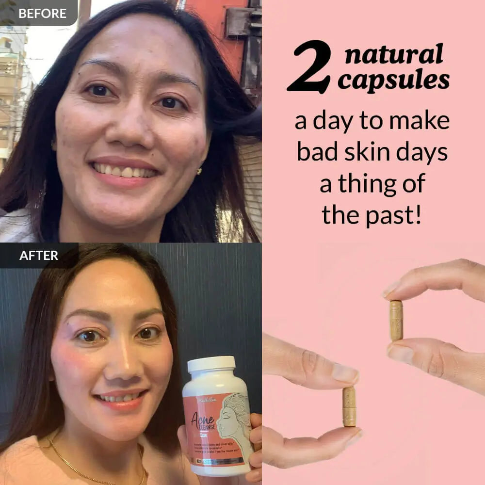 Acne Cleanse Capsules