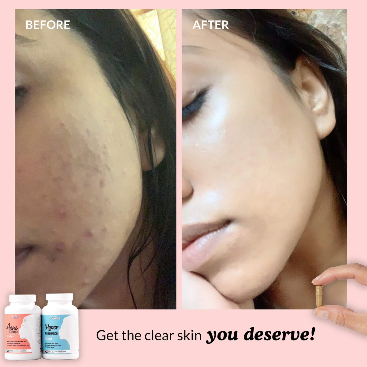Clear Complexion Kit | kallistia