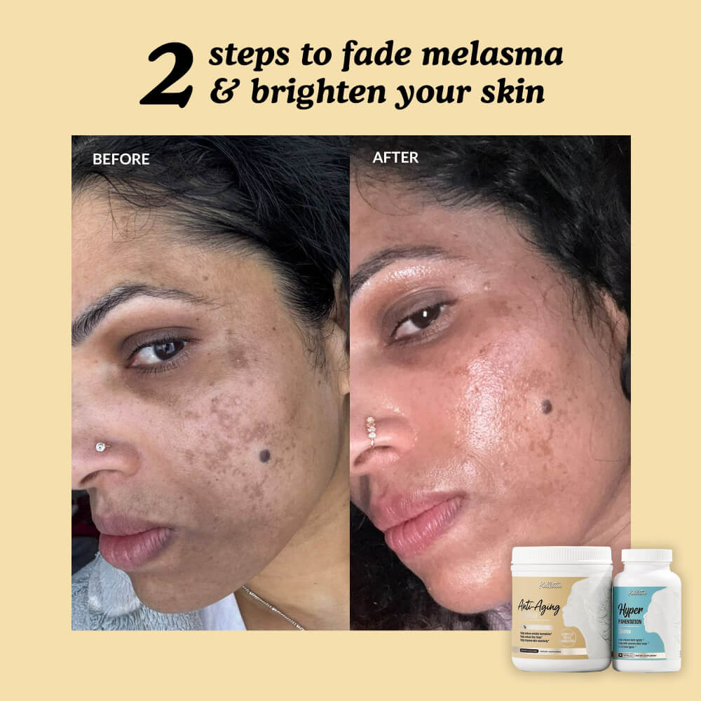 Before and after comparison of skin with melasma, featuring skincare products on a beige background.