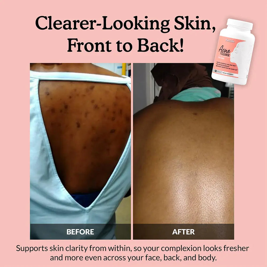 Acne Cleanse Capsules Kit