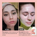 Acne Cleanse Capsules Kit