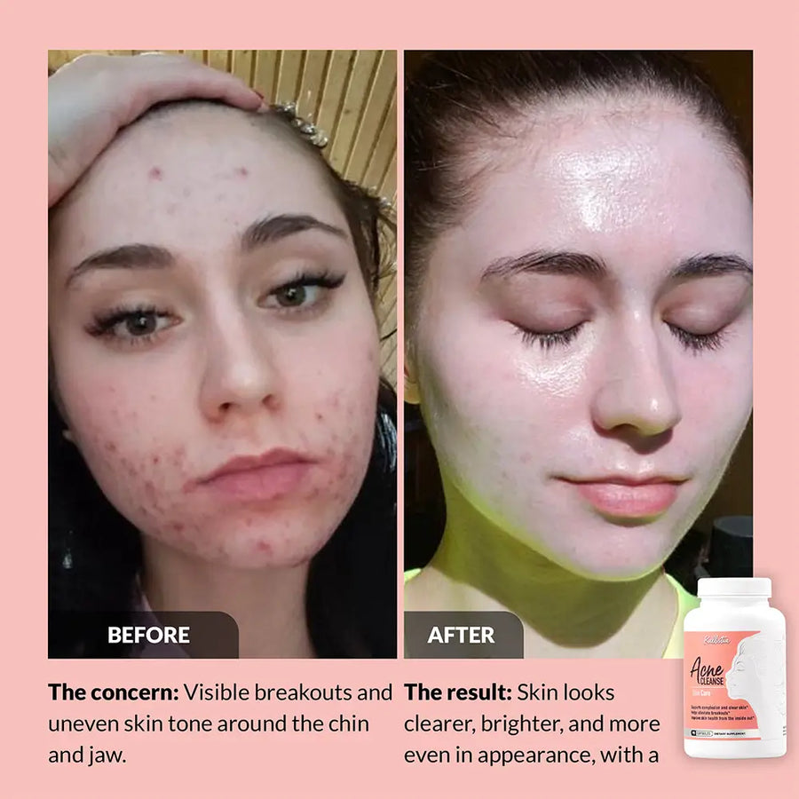 Acne Cleanse Capsules Kit