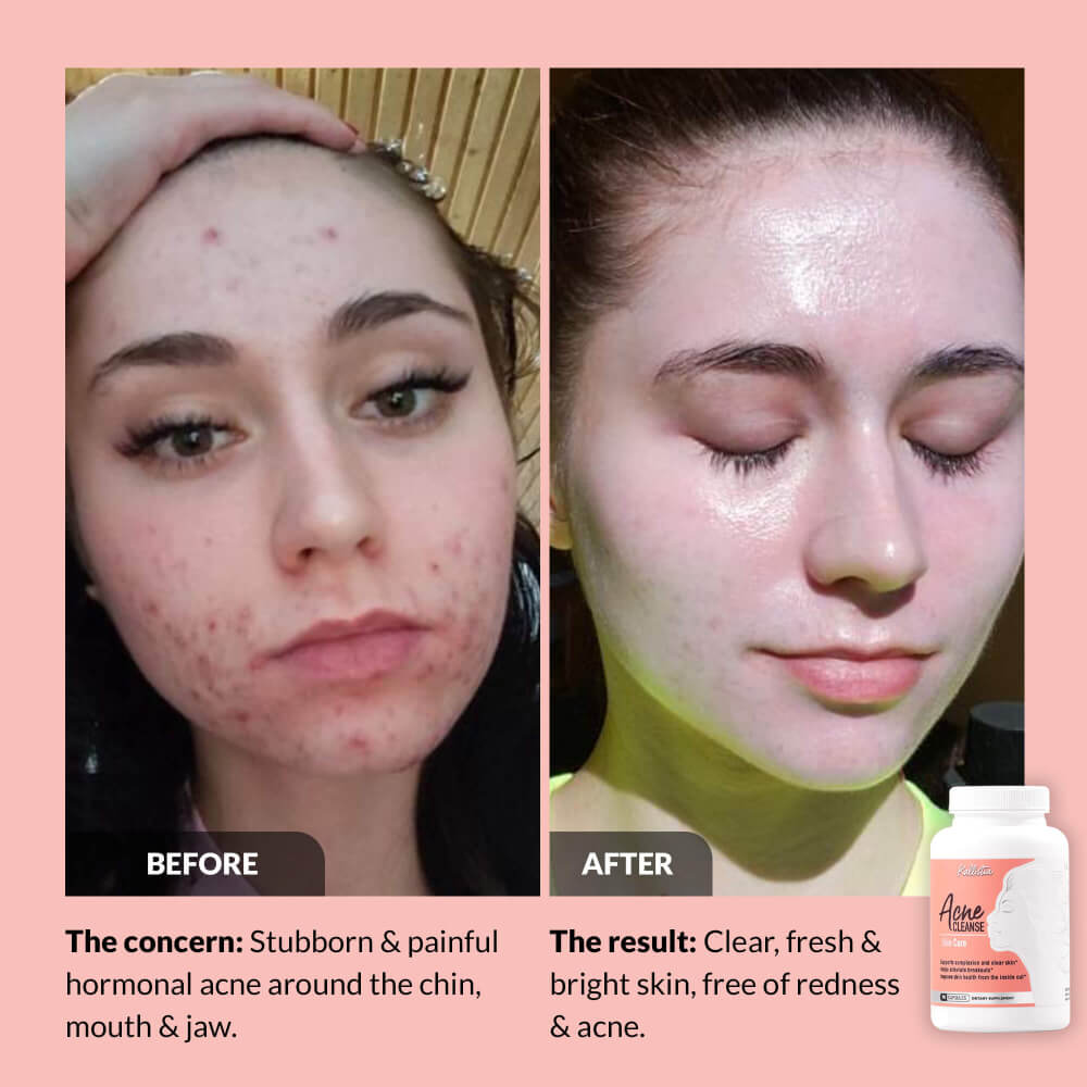 Before and after comparison of a person's face with acne, showing clear skin with a bottle of Acne treatment on a pink background.