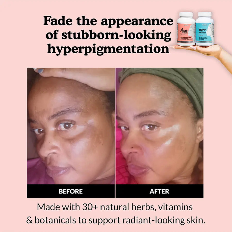Before and after comparison of skin hyperpigmentation treatment with Acne Cleanse and Hyperpigmentation Cleanse on a pink background.