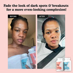 Before and after comparison of a woman with dark spots, showing her with Acne cleanse and hyperpigmentation cleanse supplement bottles