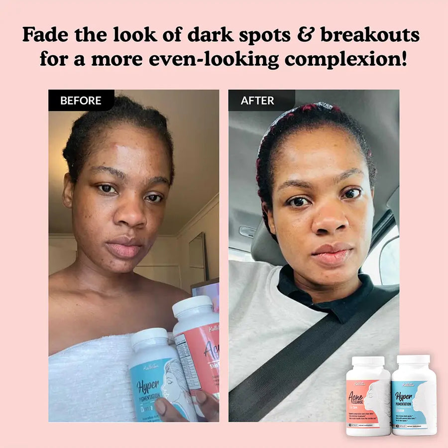 Before and after comparison of a woman with dark spots, showing her with Acne cleanse and hyperpigmentation cleanse supplement bottles