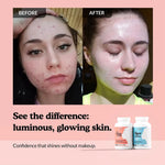Before and after comparison of a person's face with acne, followed by a glowing skin appearance, with Acne Cleanse and Hyperpigmentation Cleanse products displayed.