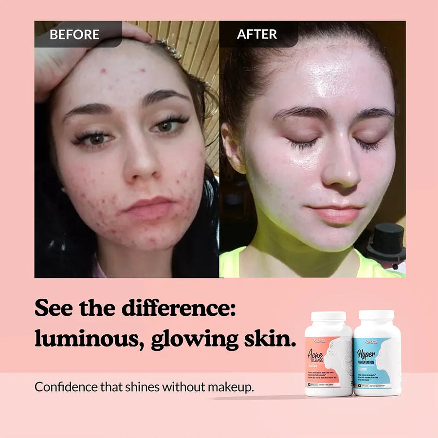 Before and after comparison of a person's face with acne, followed by a glowing skin appearance, with Acne Cleanse and Hyperpigmentation Cleanse products displayed.