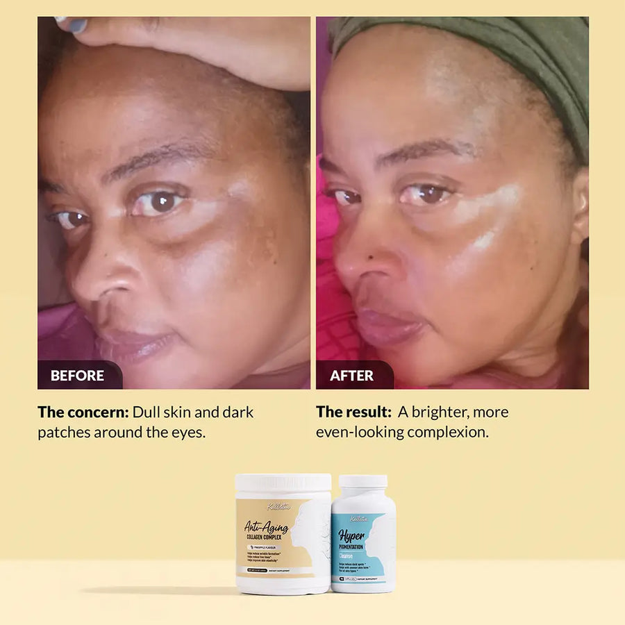 Hyper Renew Kit before and after: dull skin and dark patches around the eyes fade to a brighter, more even-looking complexion
