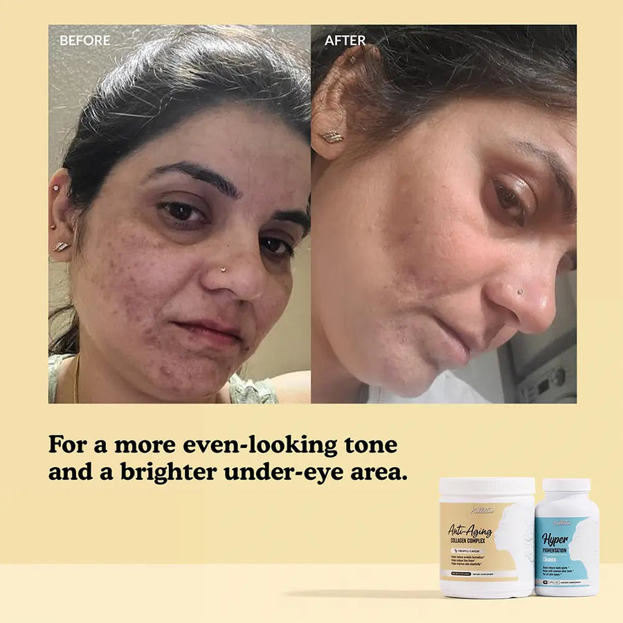 Hyper Renew Kit before and after: for a more even-looking tone and a brighter under-eye area