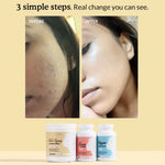 Kallistia Perfect Skin Kit before and after: clearer, smoother skin after using all three bottles