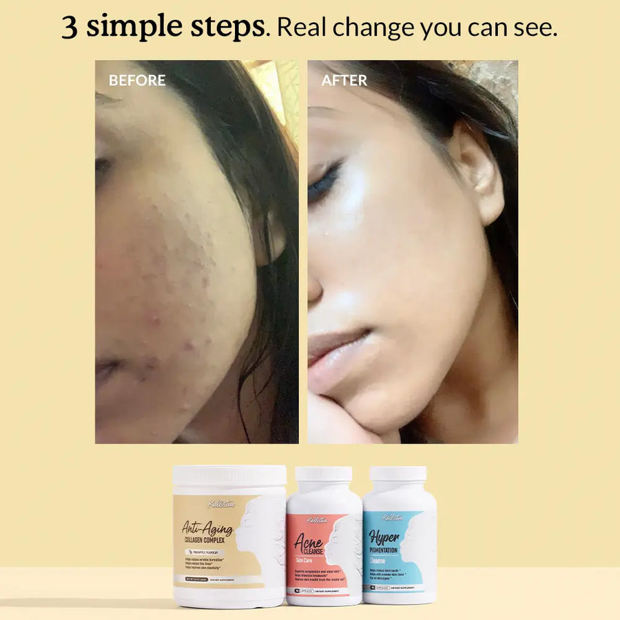 Kallistia Perfect Skin Kit before and after: clearer, smoother skin after using all three bottles