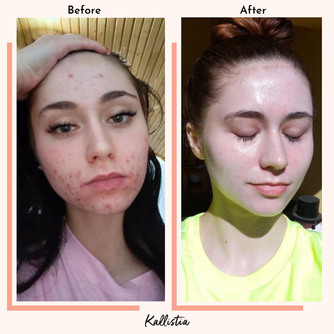 Kallista acne deals